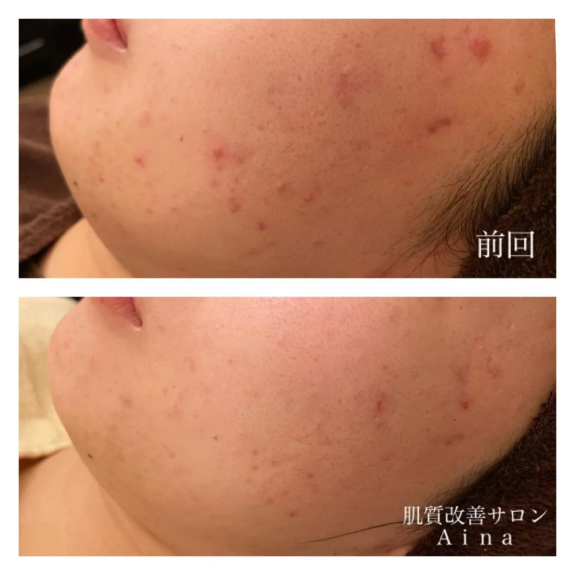 セミロング カラー パーマ ヘアアレンジ メンズ キッズ ネイル マツエク・マツパ エステ リラク ニキビ跡専門サロン Ainaのエステ・リラクイメージ