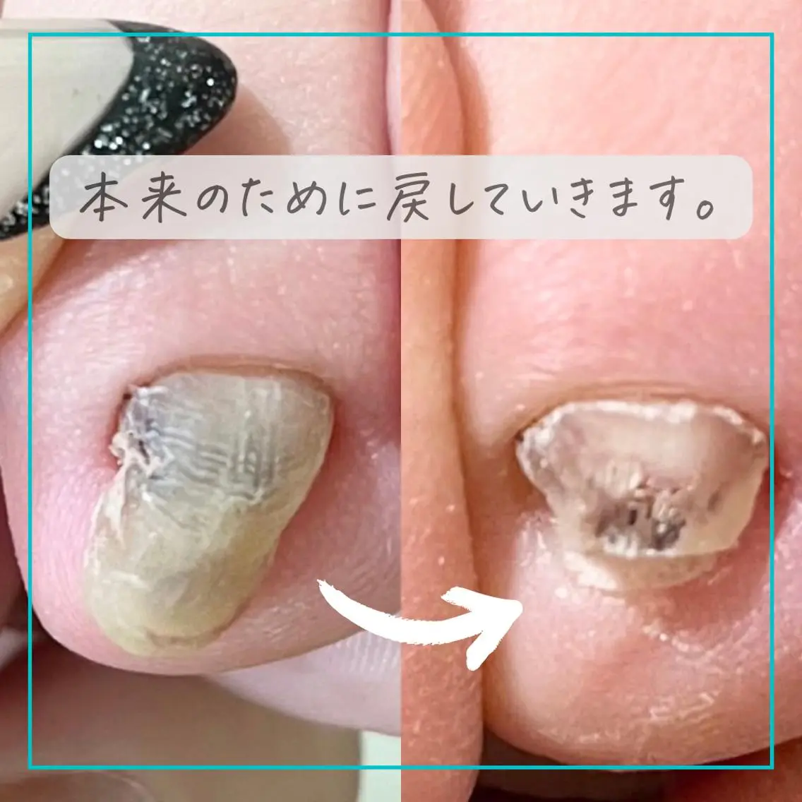 ネイル 深爪・巻き爪 専門サンセリテのネイルデザイン