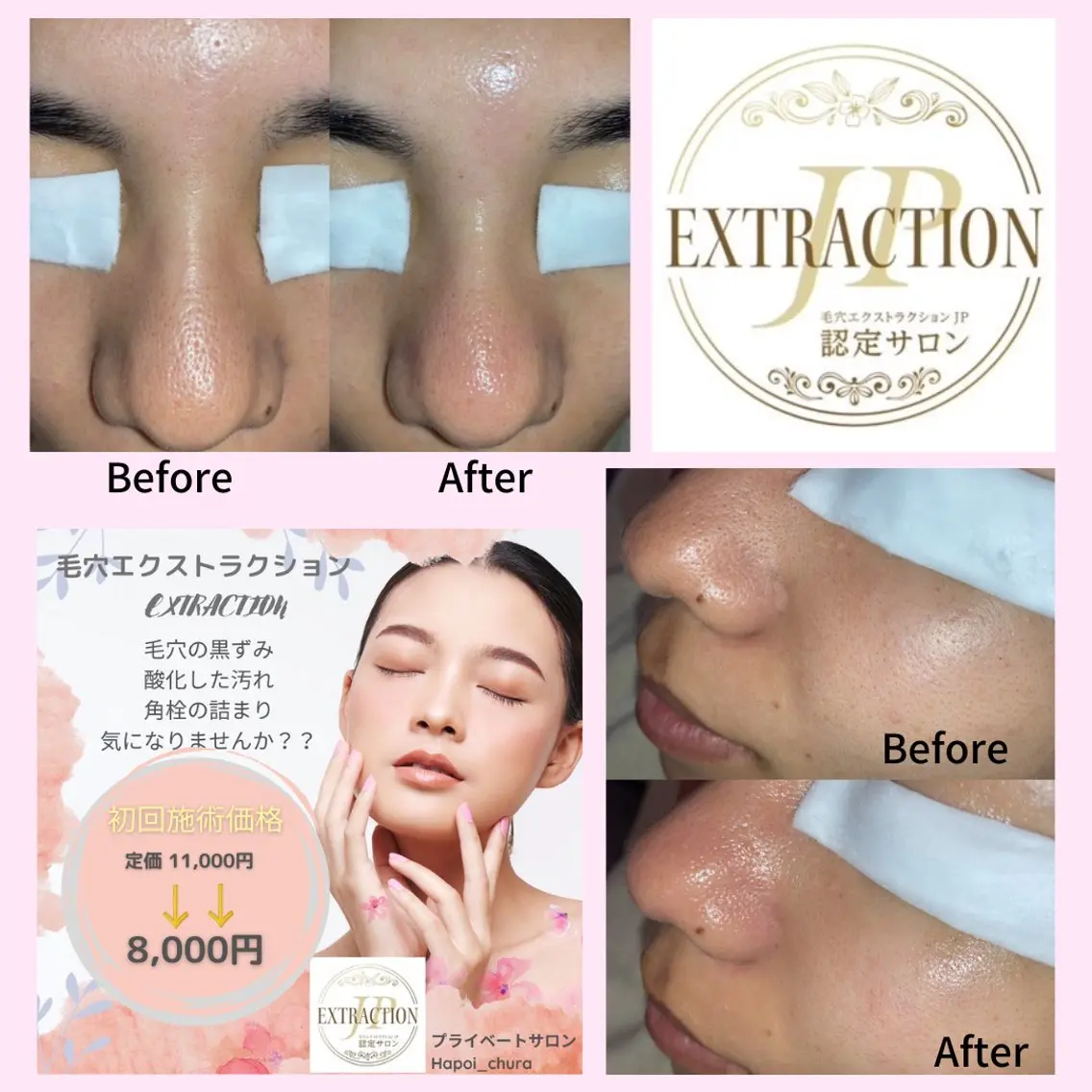 【初回】毛穴エクストラクション(毛穴洗浄)の写真
