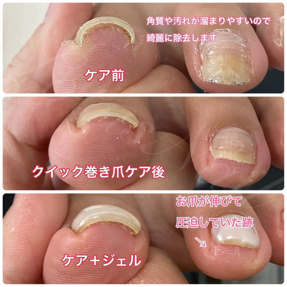 巻き爪ケア＋Footワンカラー⚠️注意事項をお読みいただきご理解の上ご予約ください。の写真