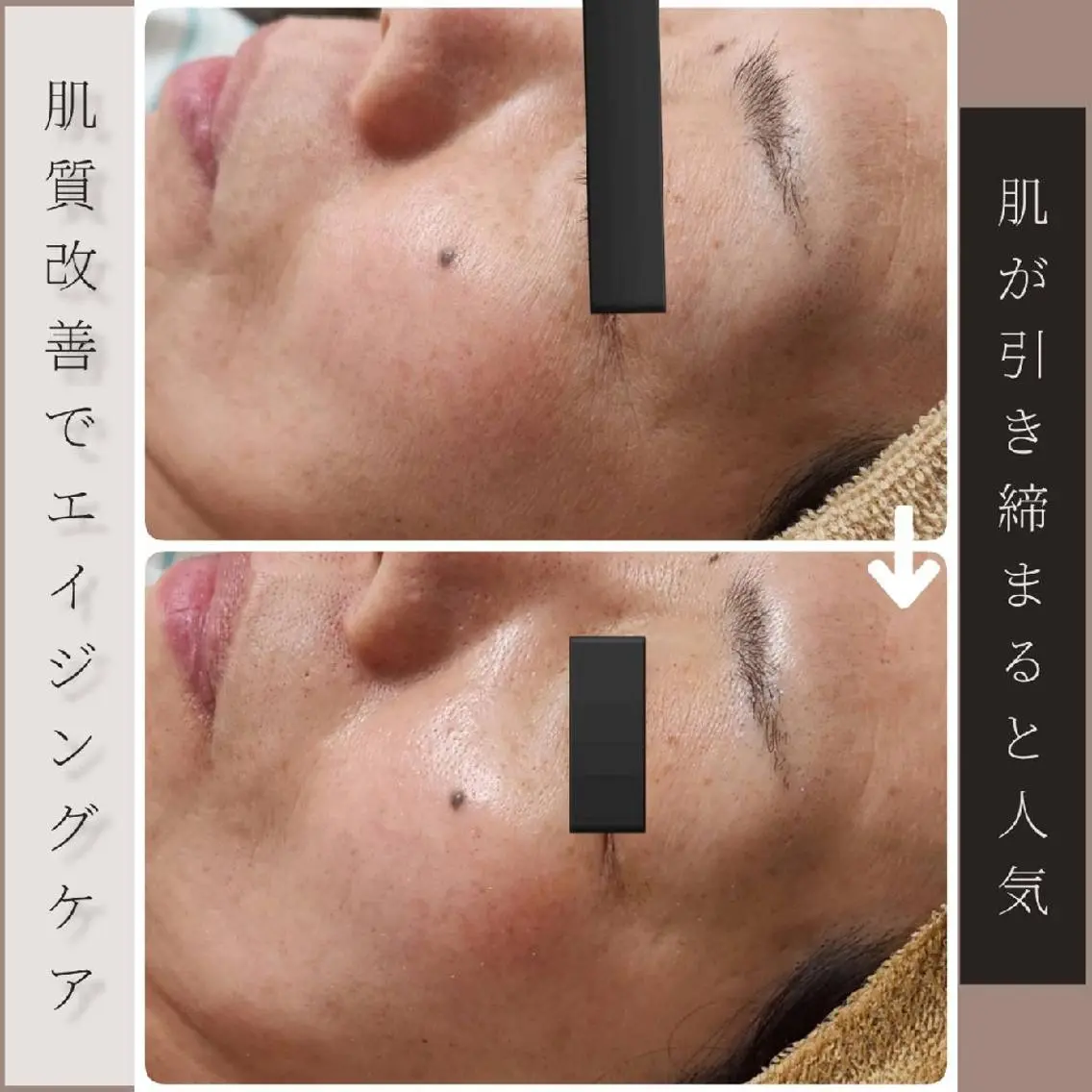 【乾燥/赤み/むくみ/シワ改善/ニキビケア】ハーブピーリング+ポレーションの写真