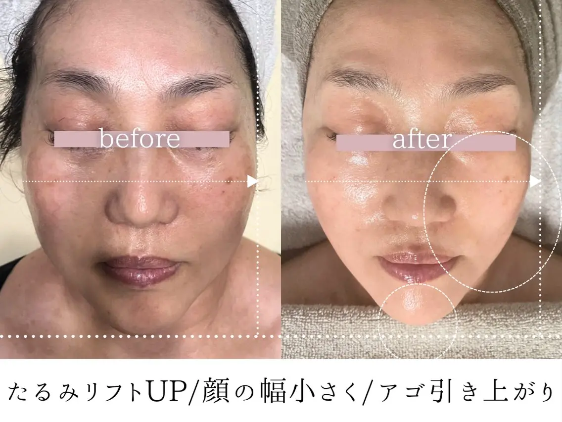 その他 頭蓋骨小顔コルギ Permのその他イメージ