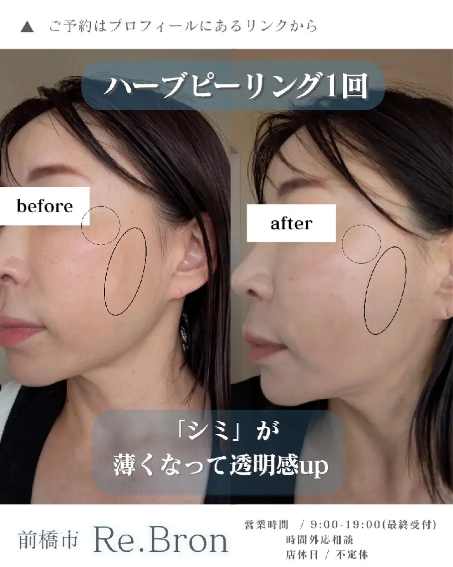 エステ リラク たるみ・ くすみ シミ・ニキビ肌改善のエステ・リラクイメージ