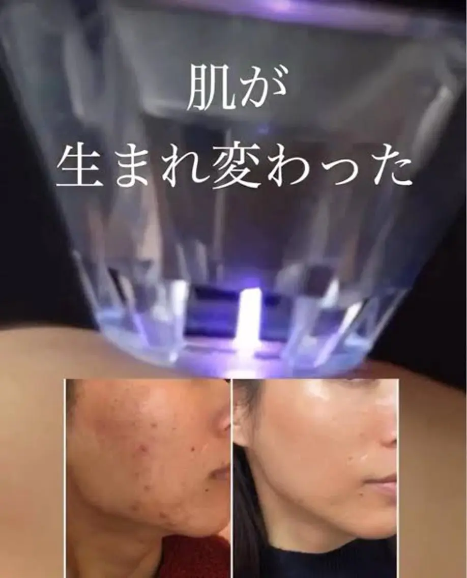 人気No.1 プラズマニードル～肌そのものを再生～の写真