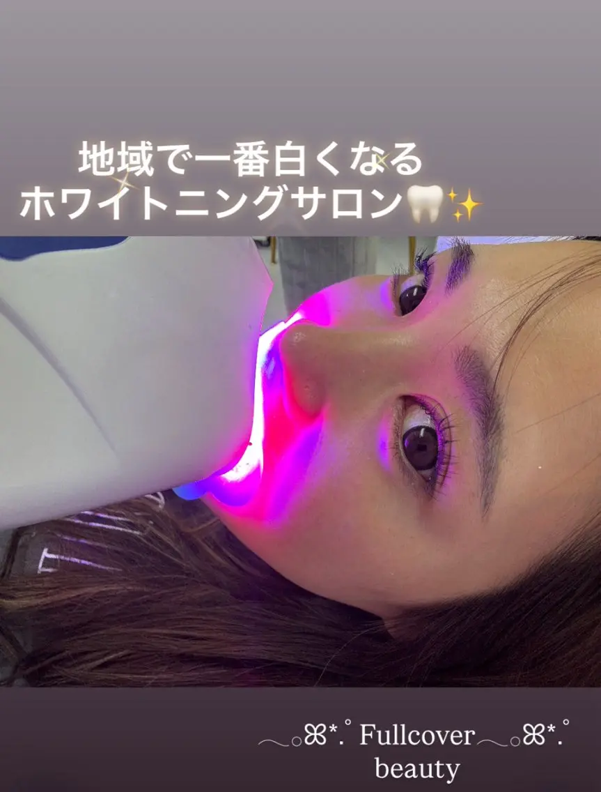 【初回限定✨】痛みなし！自然な白さへ🦷セルフホワイトニング（30分照射）の写真