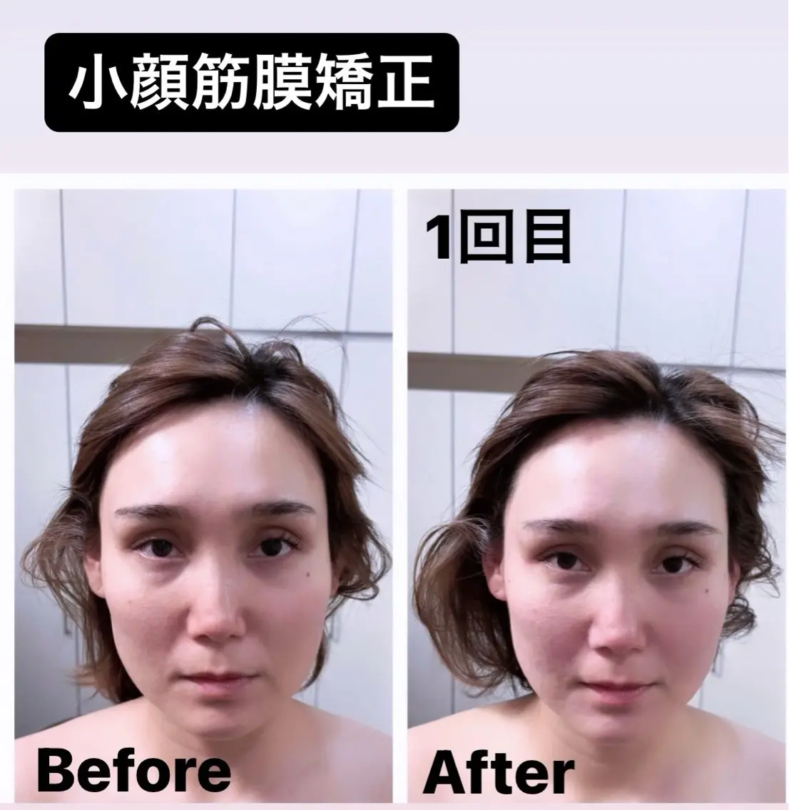 小顔筋膜矯正💆‍♀️パック付き⭐️の写真