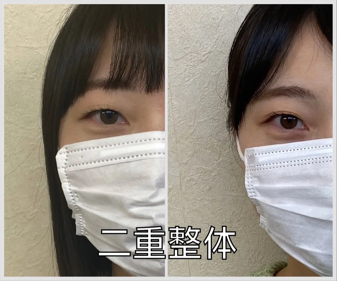 ⭐️初回モニター限定⭐️最短で二重へ! 小顔ヘッドスパ+二重整体コース✨の写真