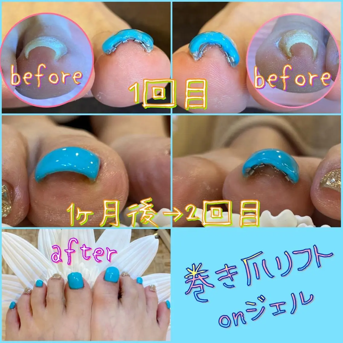 ネイル フットネイル 持ち込み 夏ネイル ♢ME2ROOM♢ #巻き爪#リラクのネイルデザイン