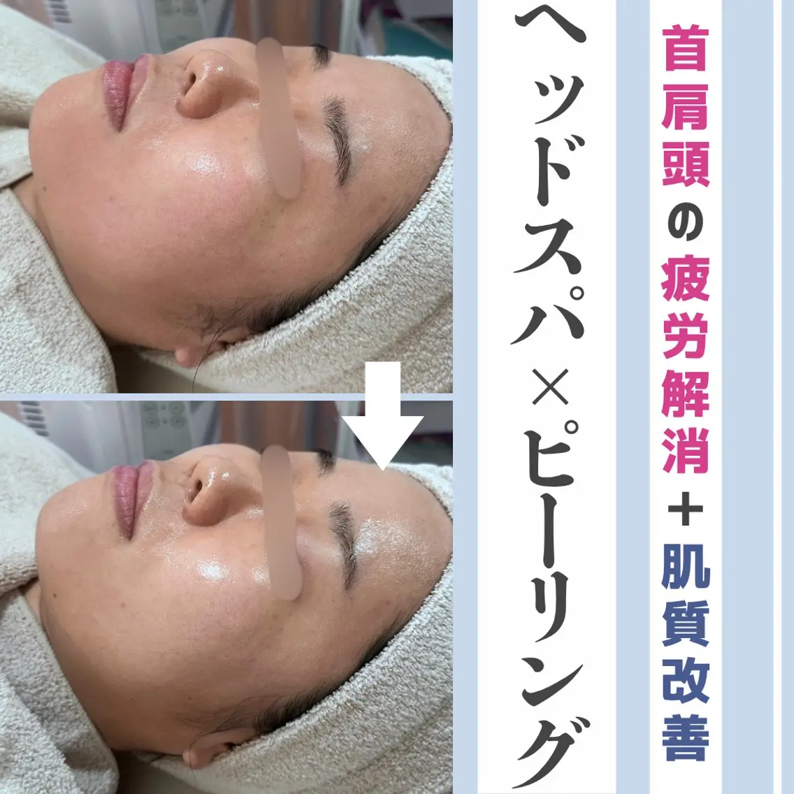 〈NEW🩵〉お好きなピーリング➕ドライヘッドスパ20分🫧の写真