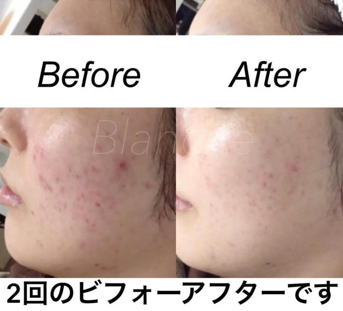 ミディアム カラー パーマ ヘアアレンジ キッズ ネイル マツエク・マツパ エステ リラク 都度払い肌質改善 &脱毛Blancheのエステ・リラクイメージ