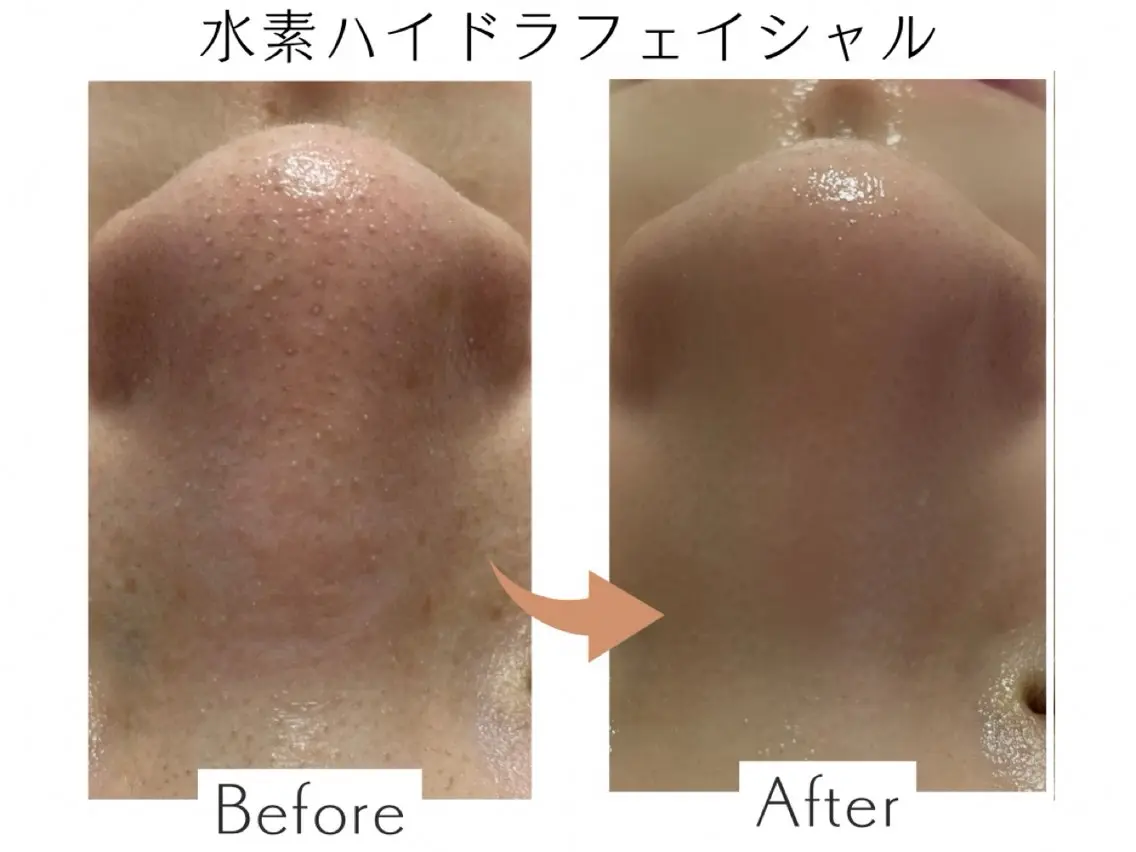 【リピート】水素ハイドラフェイシャル✨の写真