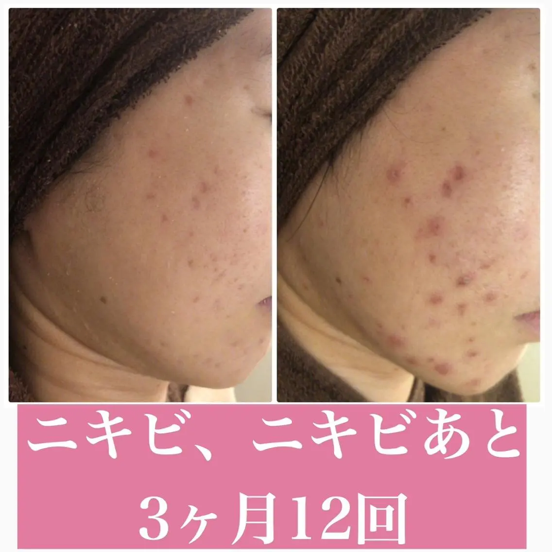 3か月で肌革命👼 ニキビ専門店💫のエステ・リラクイメージ