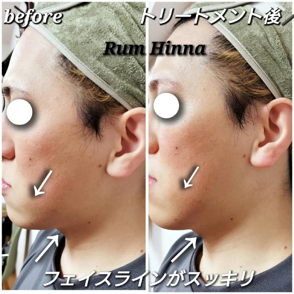 光フェイシャル★の写真