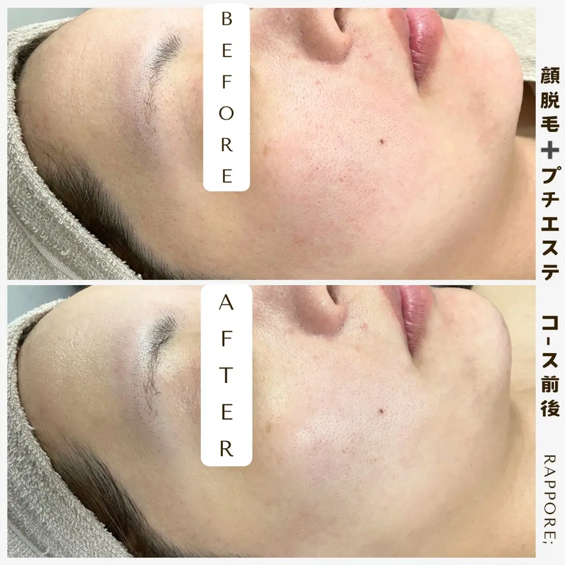 【毛穴引き締めも同時に叶う✨】レディース♡顔脱毛＋プチエステ付きの写真