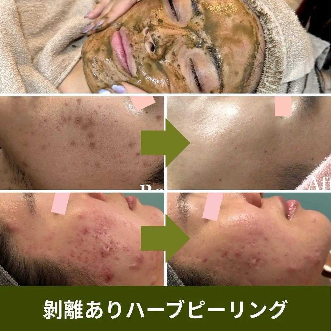 【集中肌質改善】ハーブピーリング(剥離あり)+選べるモデリングマスク|ヒト幹細胞培養上清液いり🌿クレンジング・ケア付きの写真