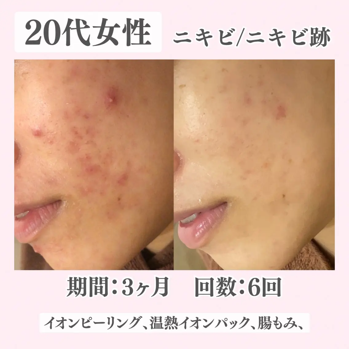 エステ リラク ニキビ・肌質改善専門 ♡人生が変わるサロンのエステ・リラクイメージ