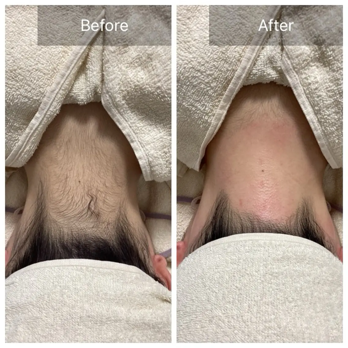 【うなじWax脱毛】自己処理なしで簡単うなじ美人✨30分の写真