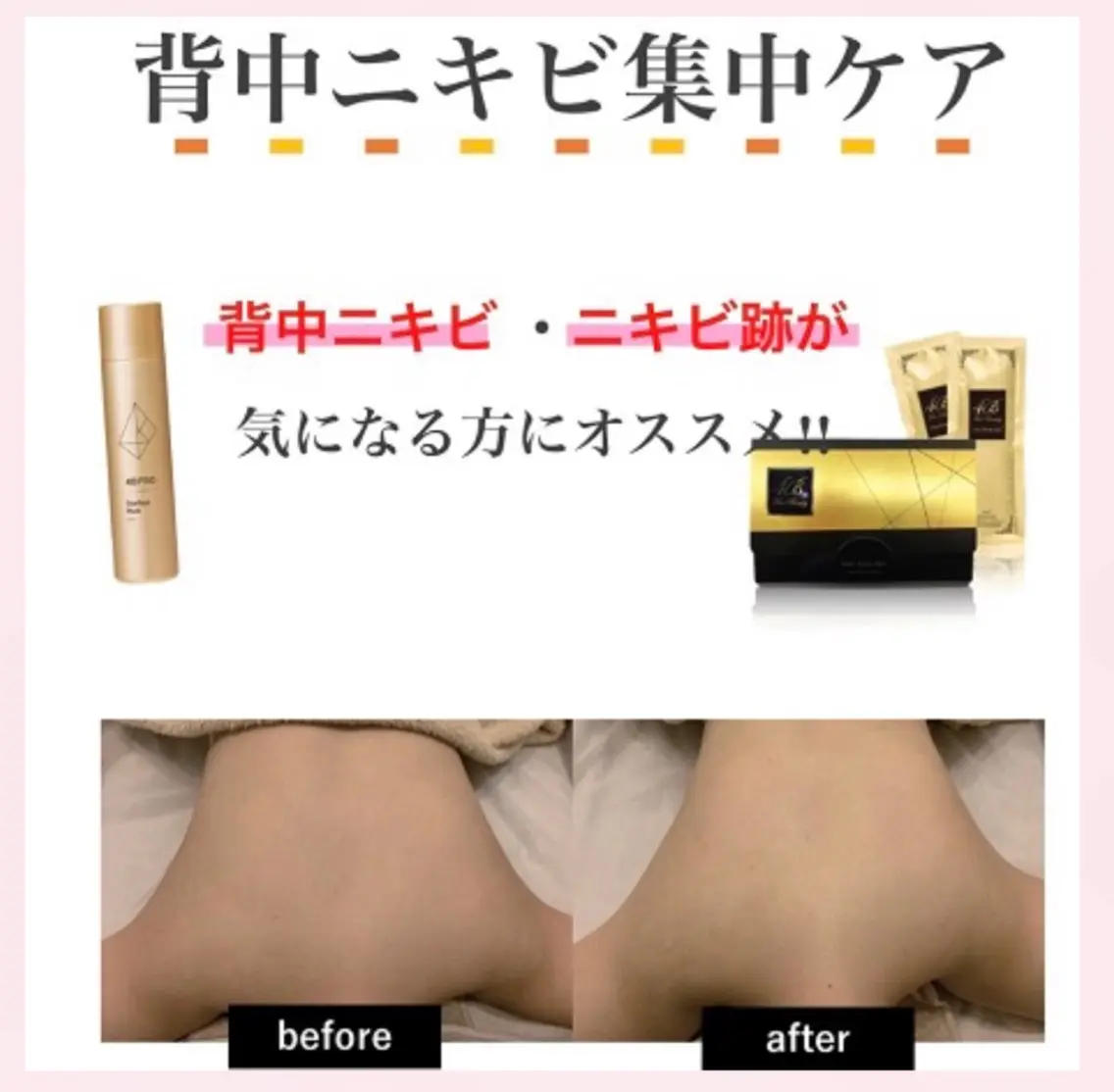 最新!プラズマ光!背中ニキビケアの写真