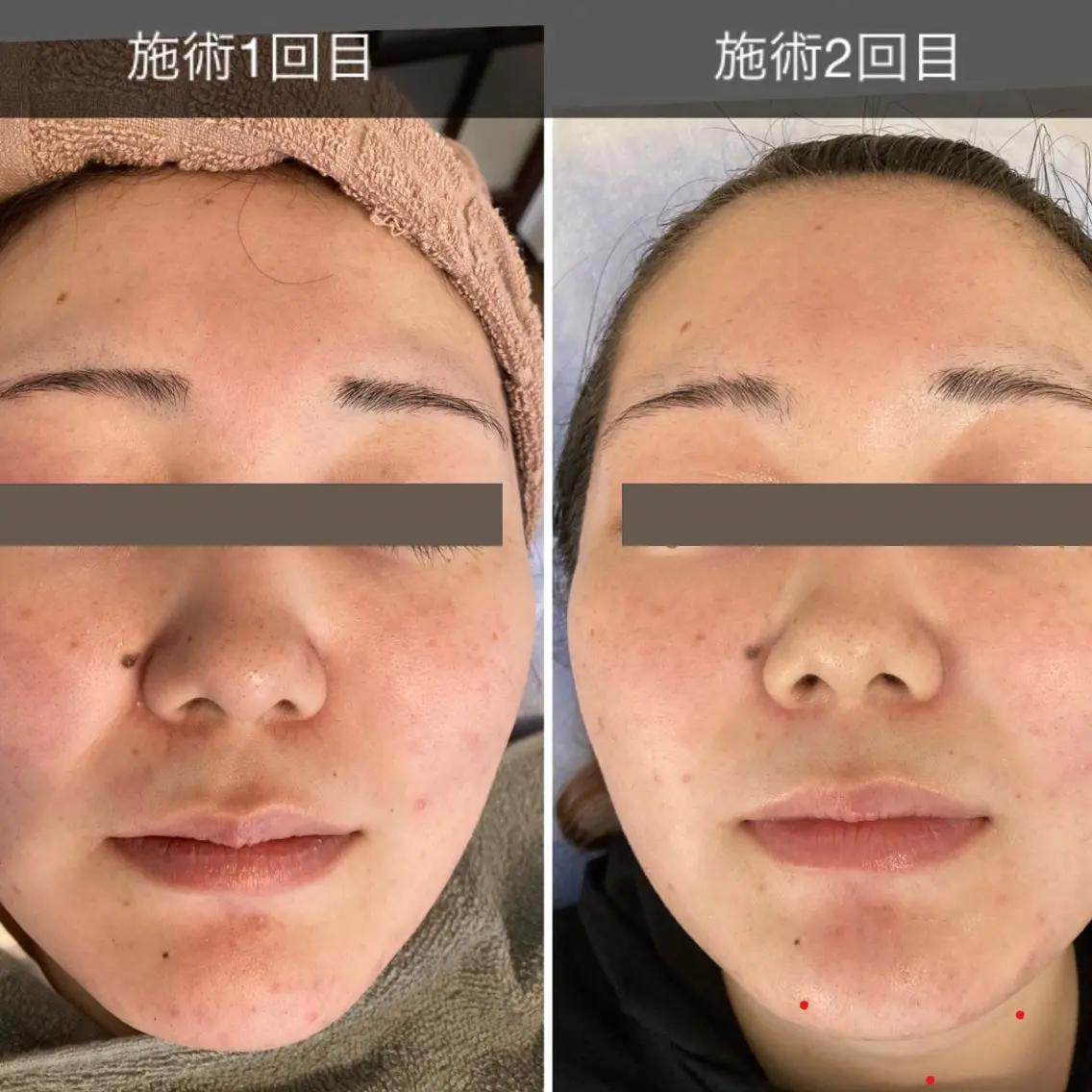 たるみ引きあげ毛穴をキュッ仕上げにあなたに合った濃厚お顔を選出し極上パック💆‍♀️ウルルンお肌へ！！の写真