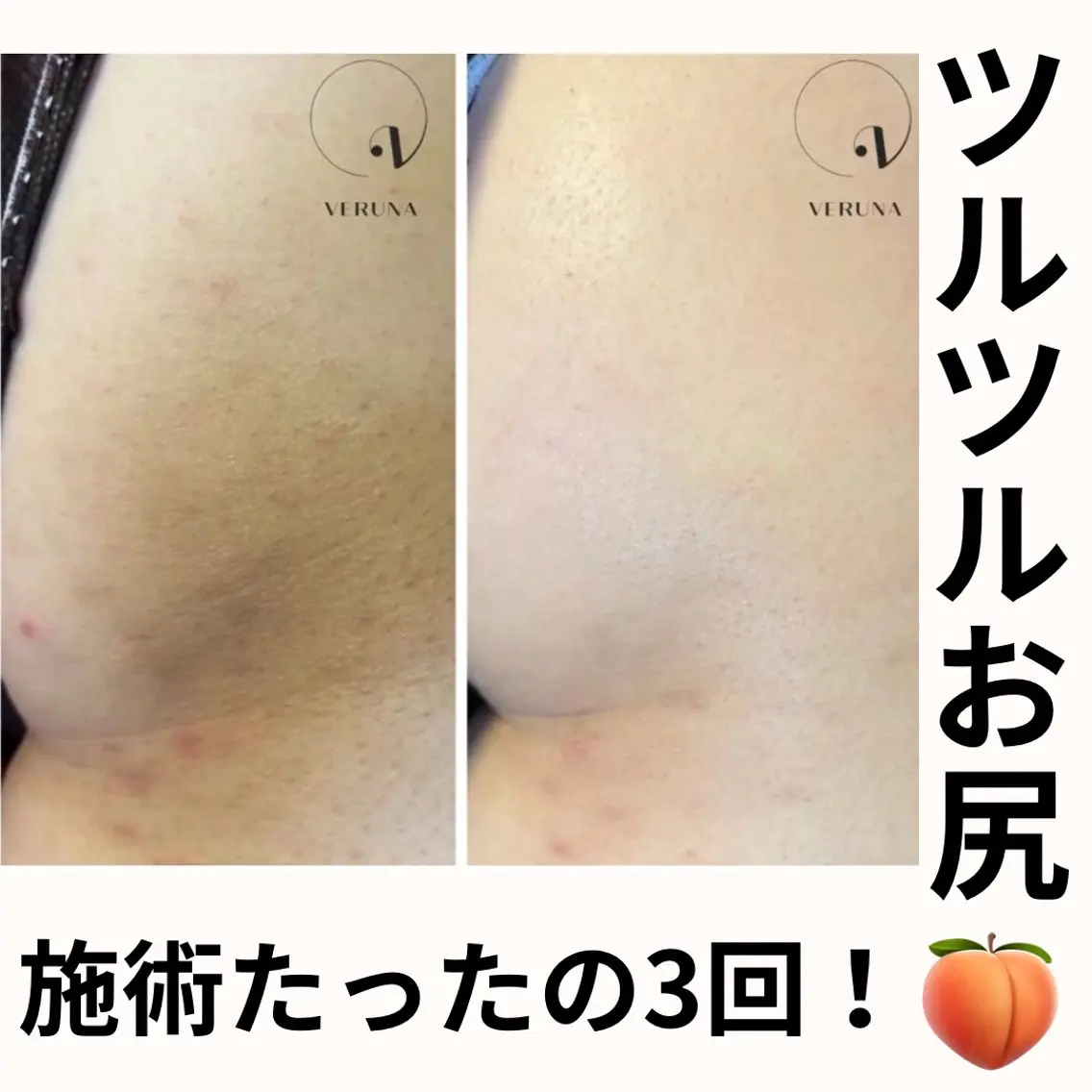 お尻のニキビ、黒ずみに！剥離有りハーブピーリング🌿の写真