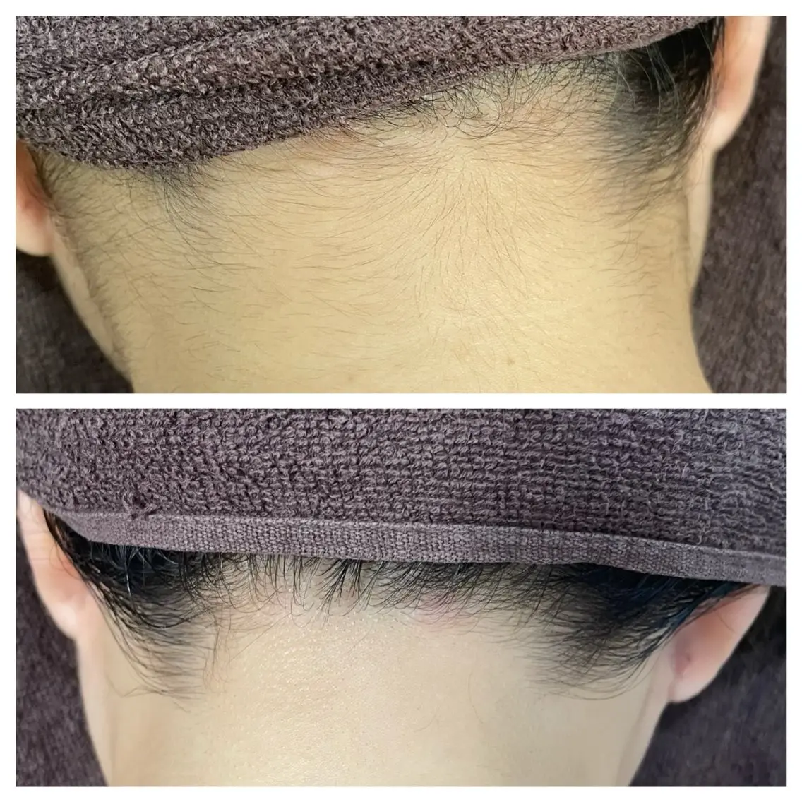 うなじシェービング🪒＋光脱毛お試し価格💁‍♀️の写真