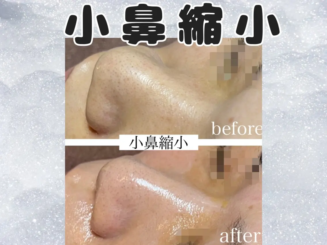 小鼻縮小ケア★幹細胞水光肌リフティング付きの写真