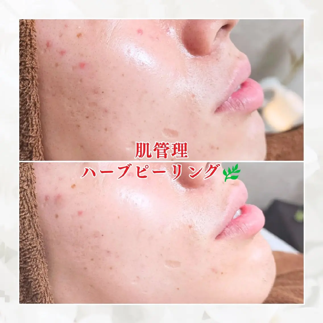 メンズもOK！肌荒れ知らず！ハーブピーリング🌿の写真