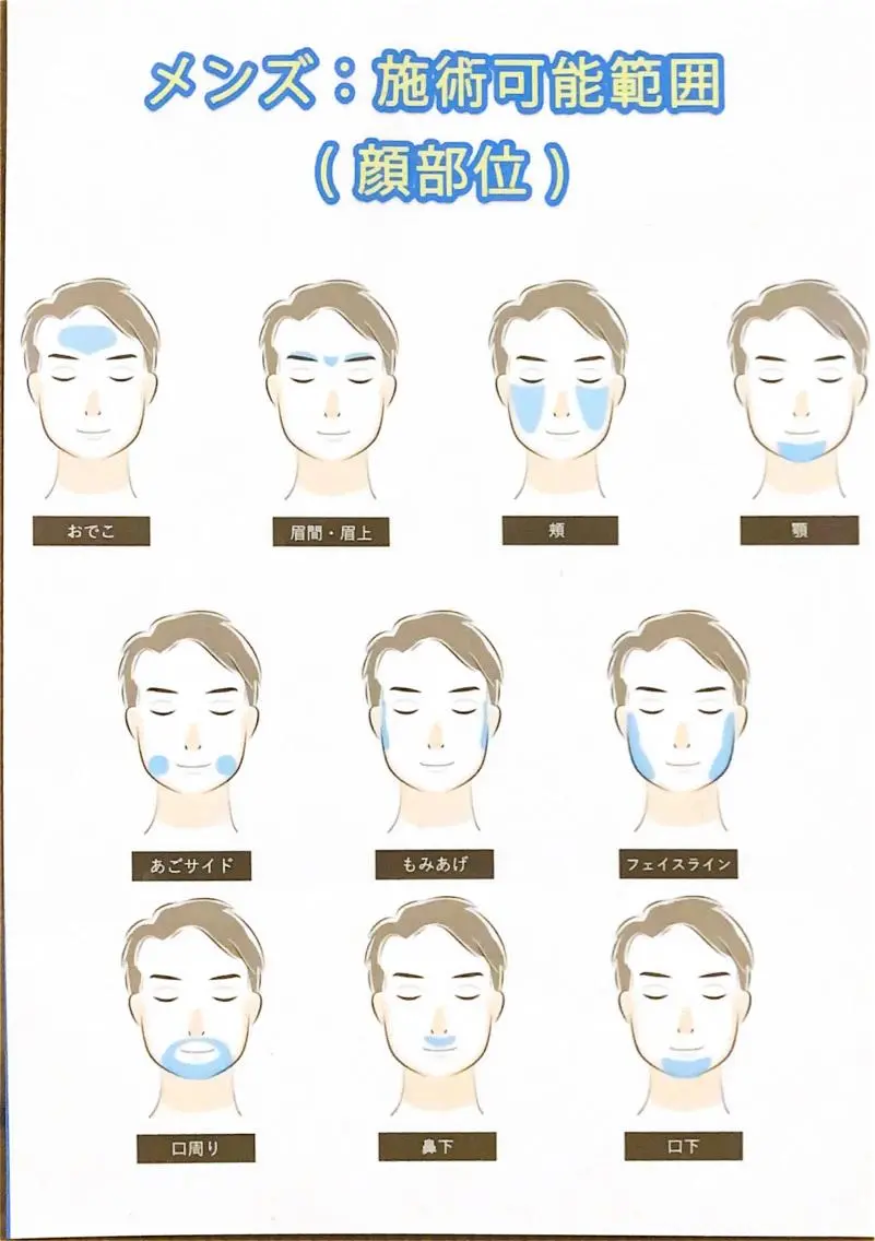 男性🚹【顔脱毛】都度払いの写真