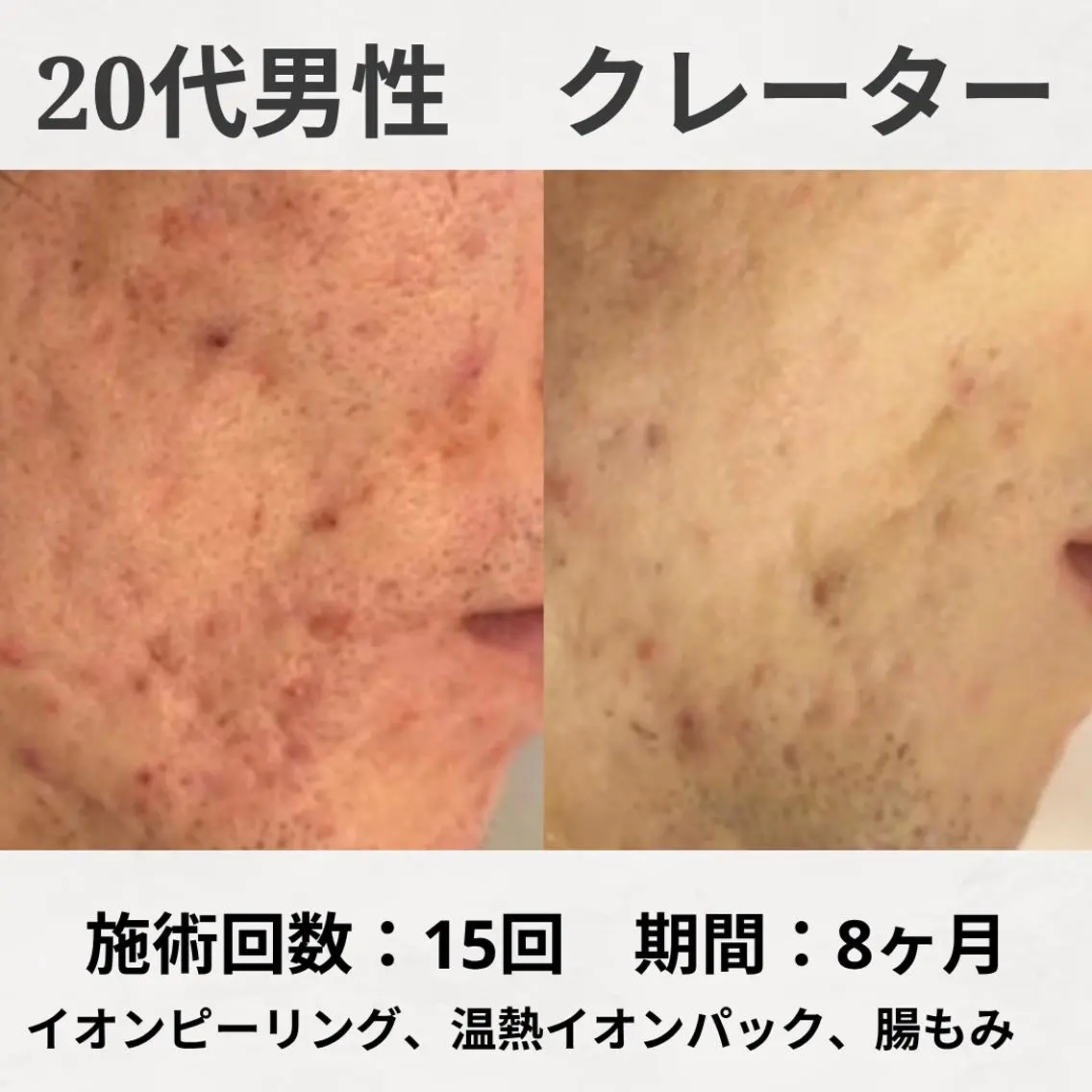 エステ リラク ニキビ跡改善専門🔥 医療にはできない改善のエステ・リラクイメージ