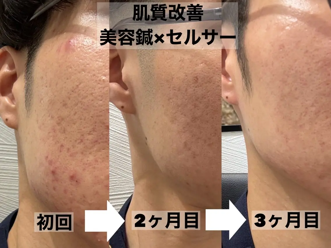 エステ リラク 大阪上本町 肌質改善×美容鍼ゆいのエステ・リラクイメージ