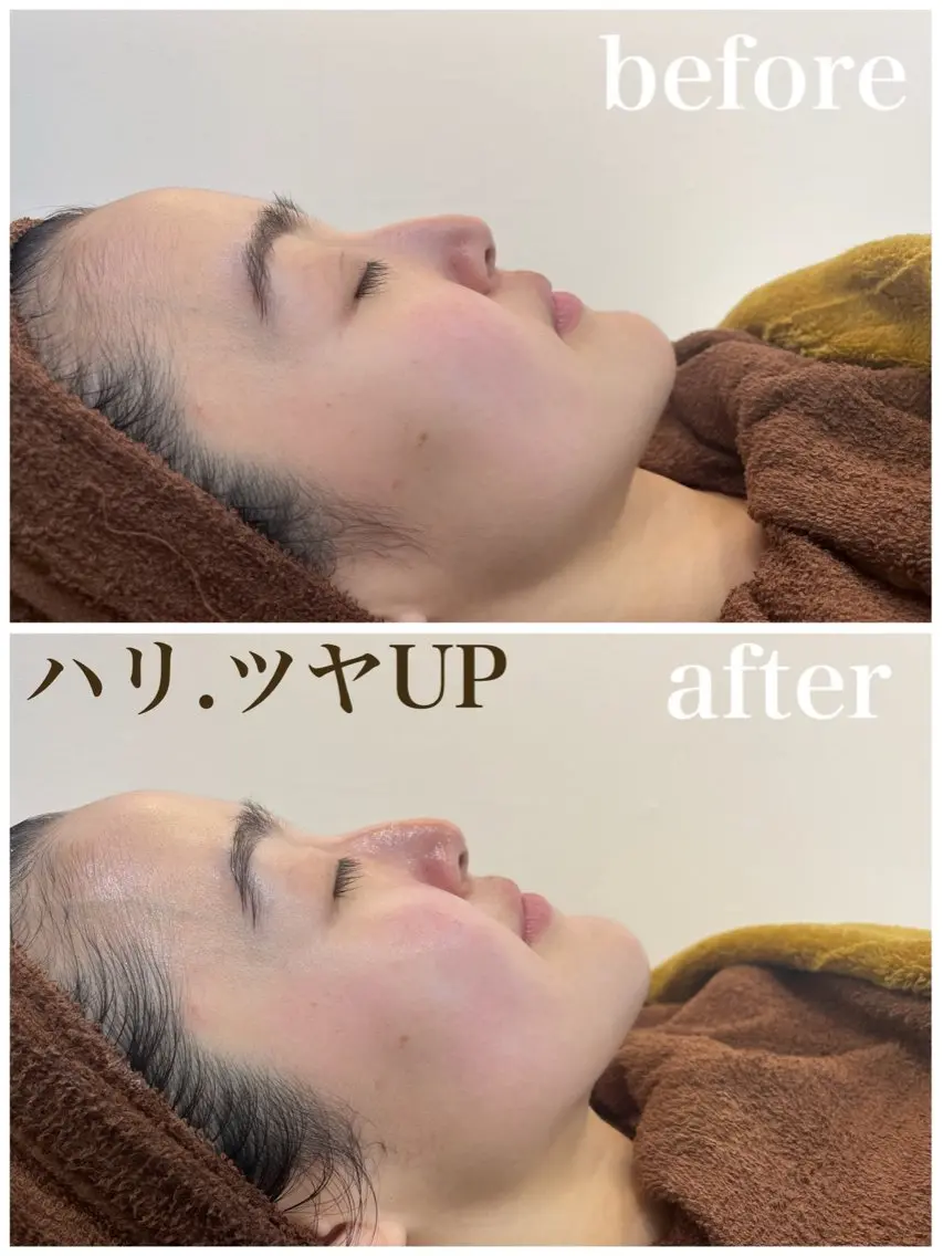 【EMS×導入ケア】ハリ・ツヤ感を目指す✨スペシャルフェイシャル（毛穴洗浄付）の写真