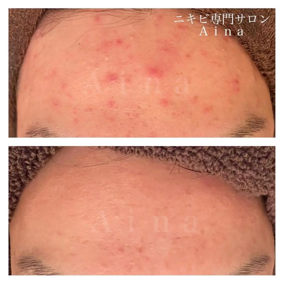 セミロング カラー パーマ ヘアアレンジ メンズ キッズ ネイル マツエク・マツパ アイブロウ 赤色 エステ リラク ニキビ跡専門サロン Ａｉｎａのエステ・リラクイメージ