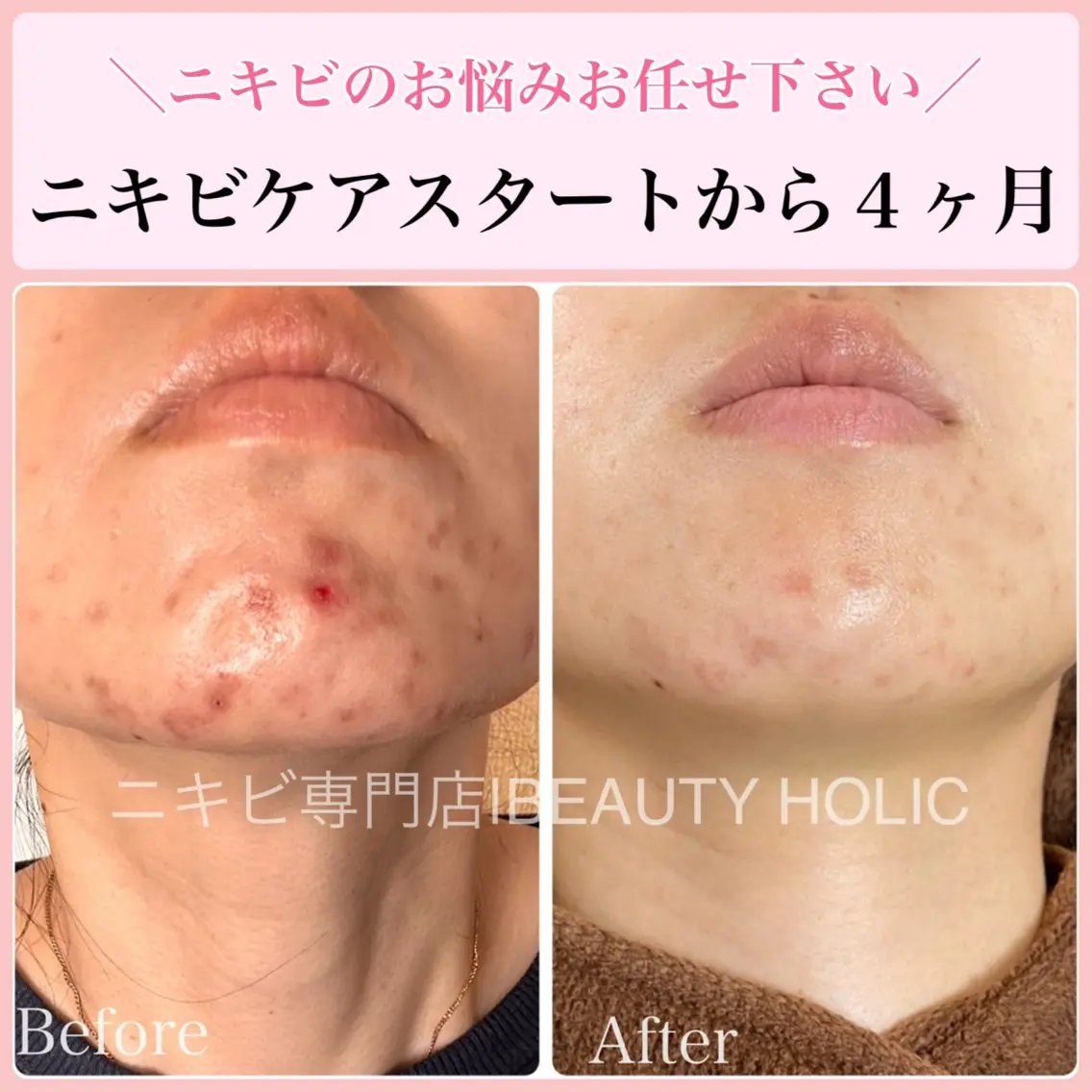 エステ リラク ニキビ・ 肌荒れ専門店のエステ・リラクイメージ