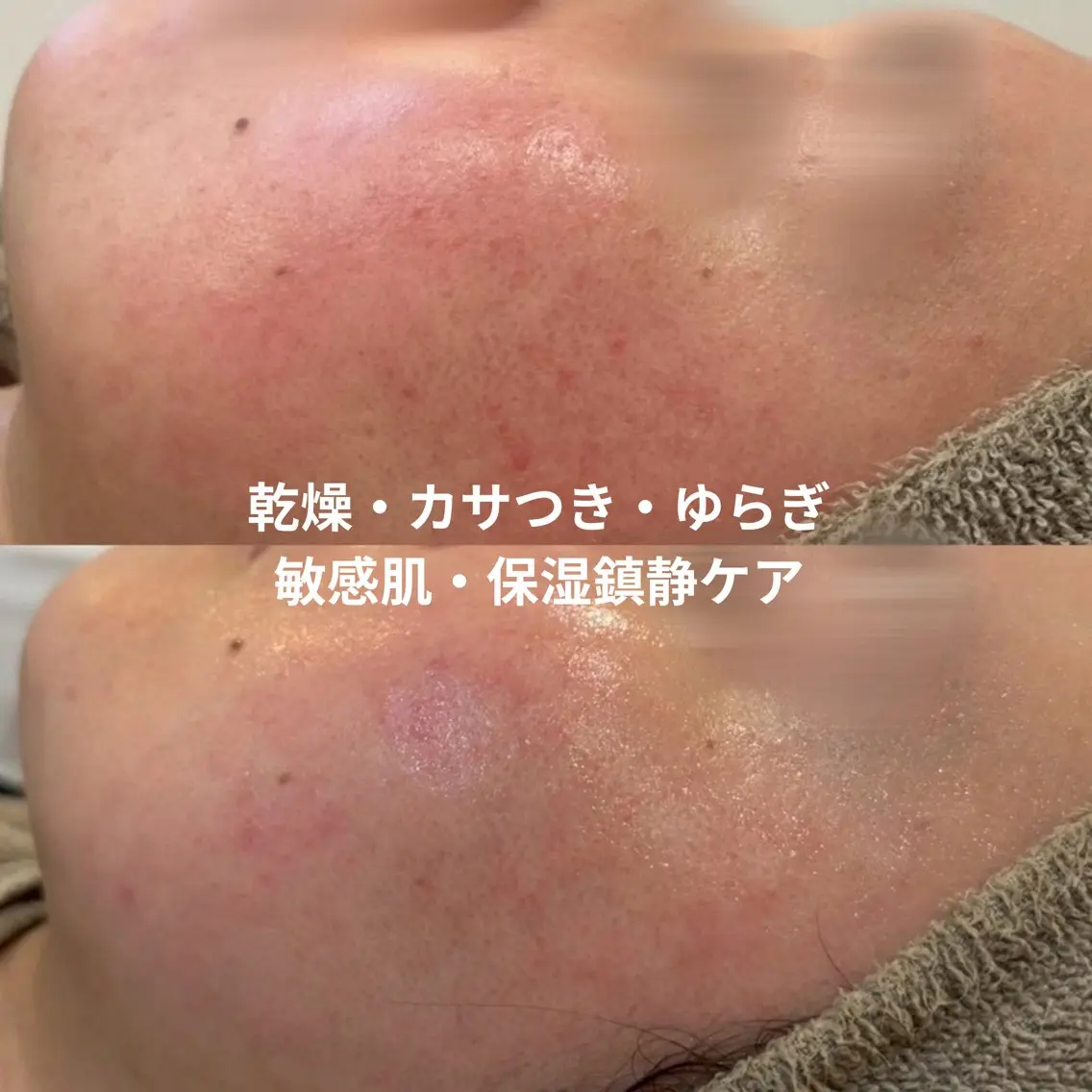 【初回】敏感肌・保湿鎮静ケア🫧乾燥・カサつき・肌のゆらぎにの写真