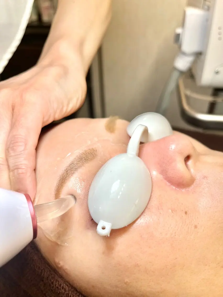 女性/初回限定🌸お顔全体脱毛☆極細ヘッド使用で眉下、眉間なども細かく隅々まで脱毛✨の写真