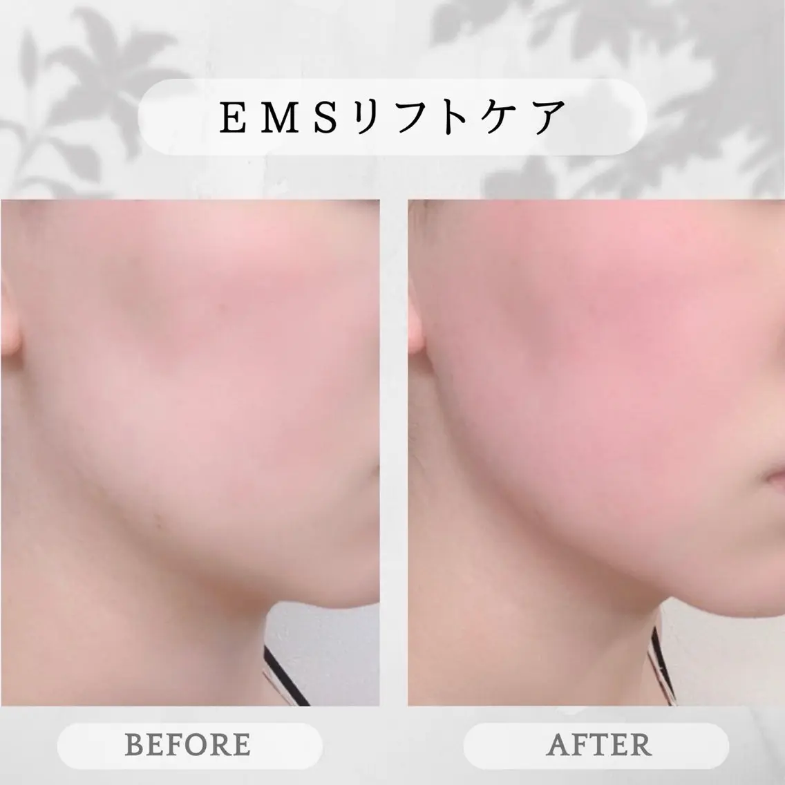 💎EMSリフトケア💎《たるみ・フェイスラインが気になる方》の写真