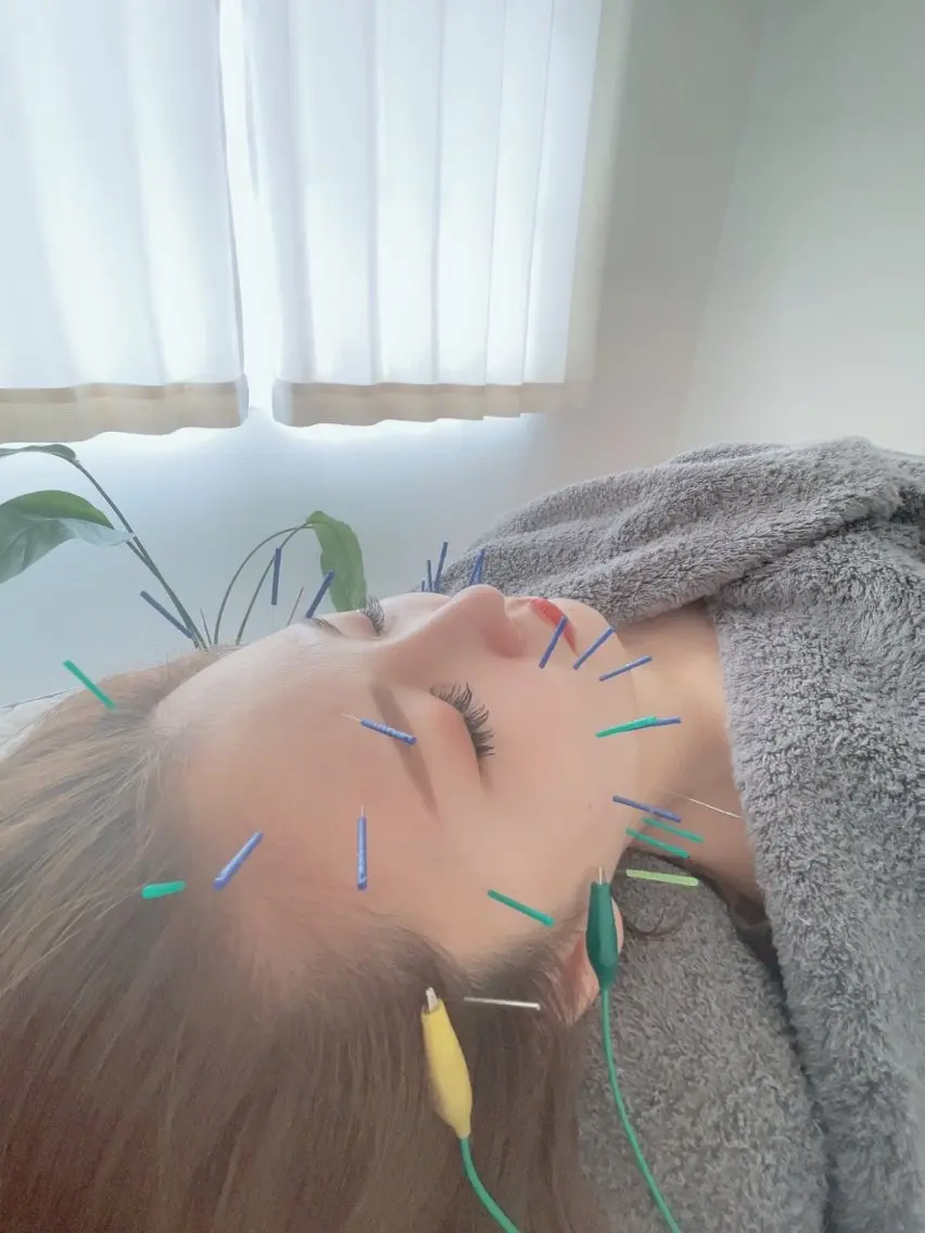 《初めての方限定!!✨》スタンダート美容鍼コース60分🌼の写真