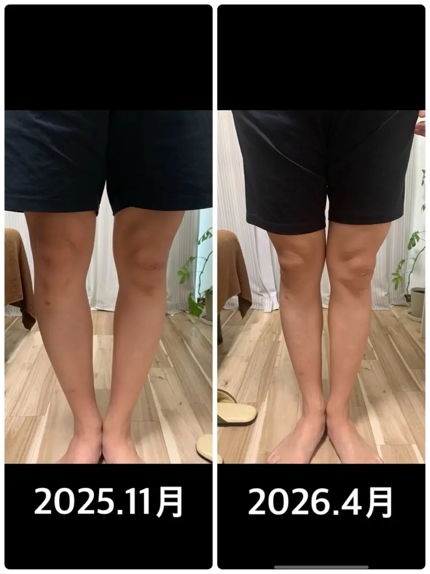 骨盤矯正、O脚矯正の写真