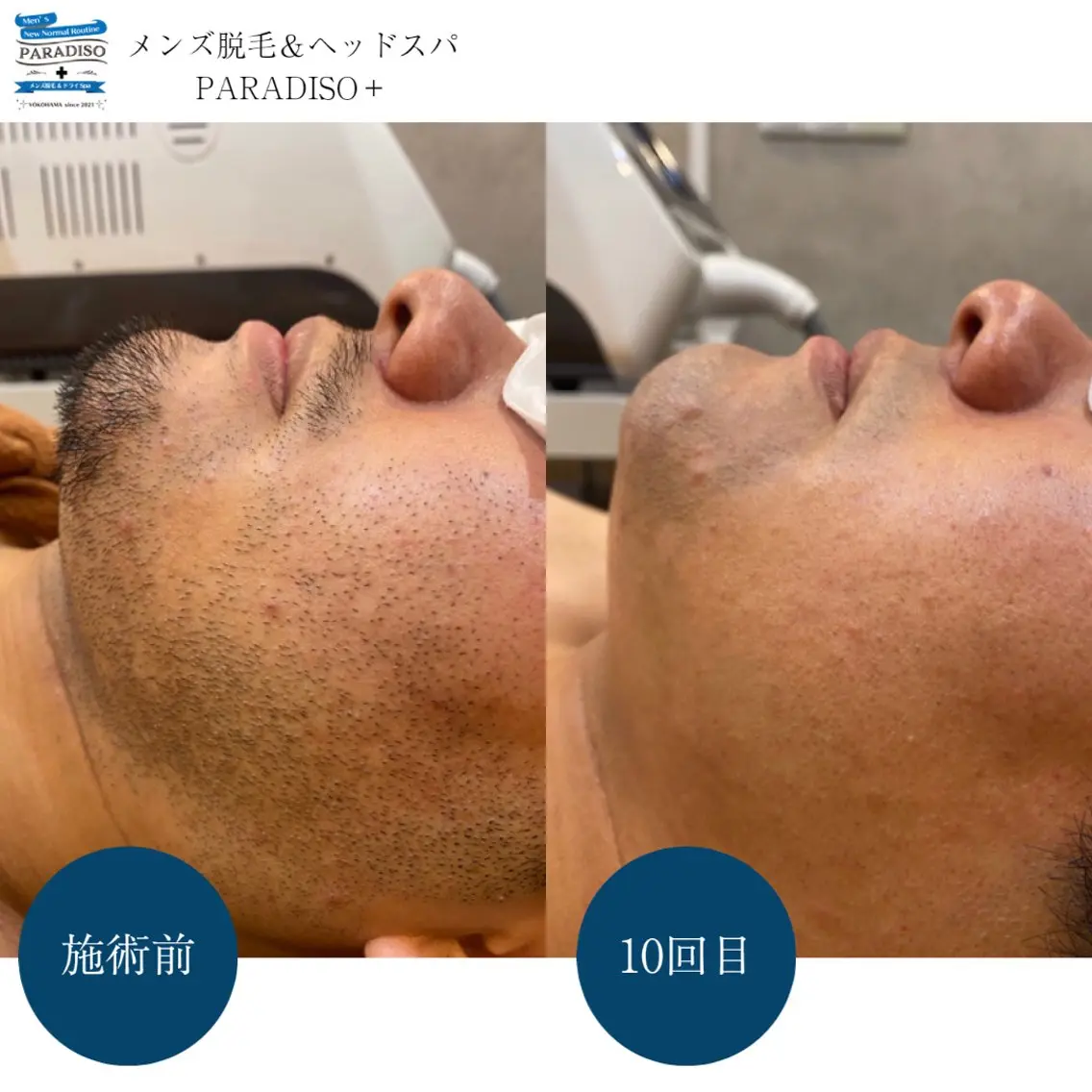 【メンズ脱毛】ヒゲ全体の写真