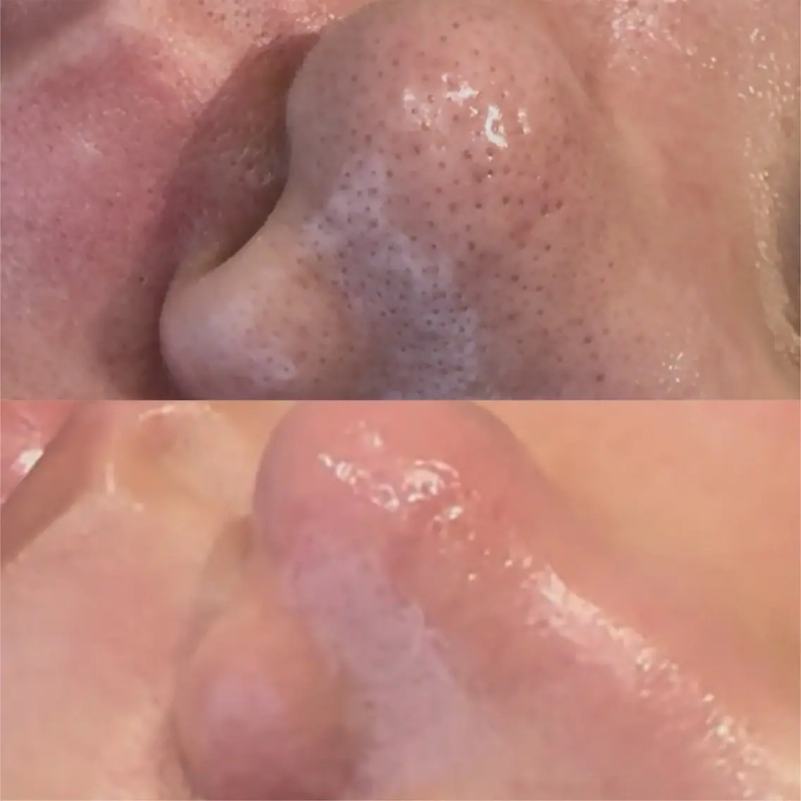 鼻のみWAX脱毛×鼻のみ毛穴洗浄の写真