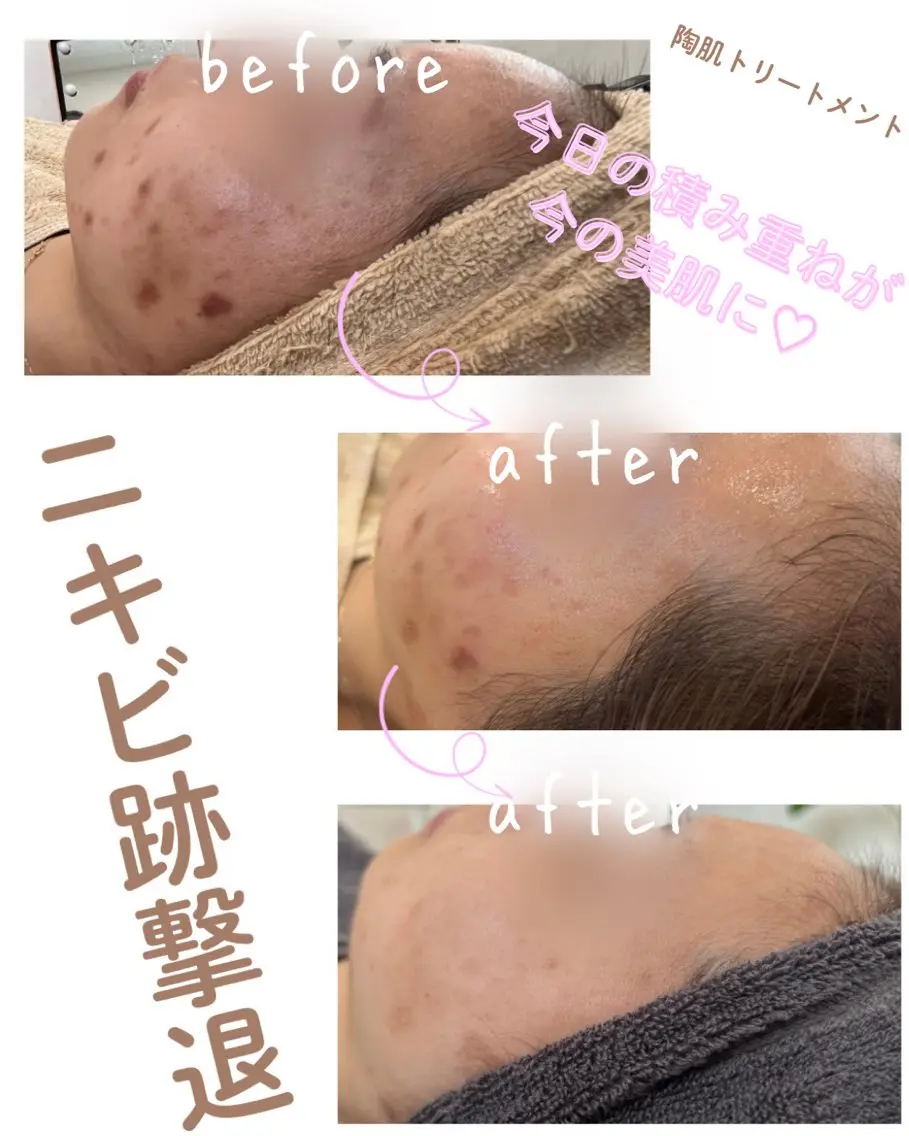 エステ miki 東根の肌質改善サロンのエステ・リラクイメージ