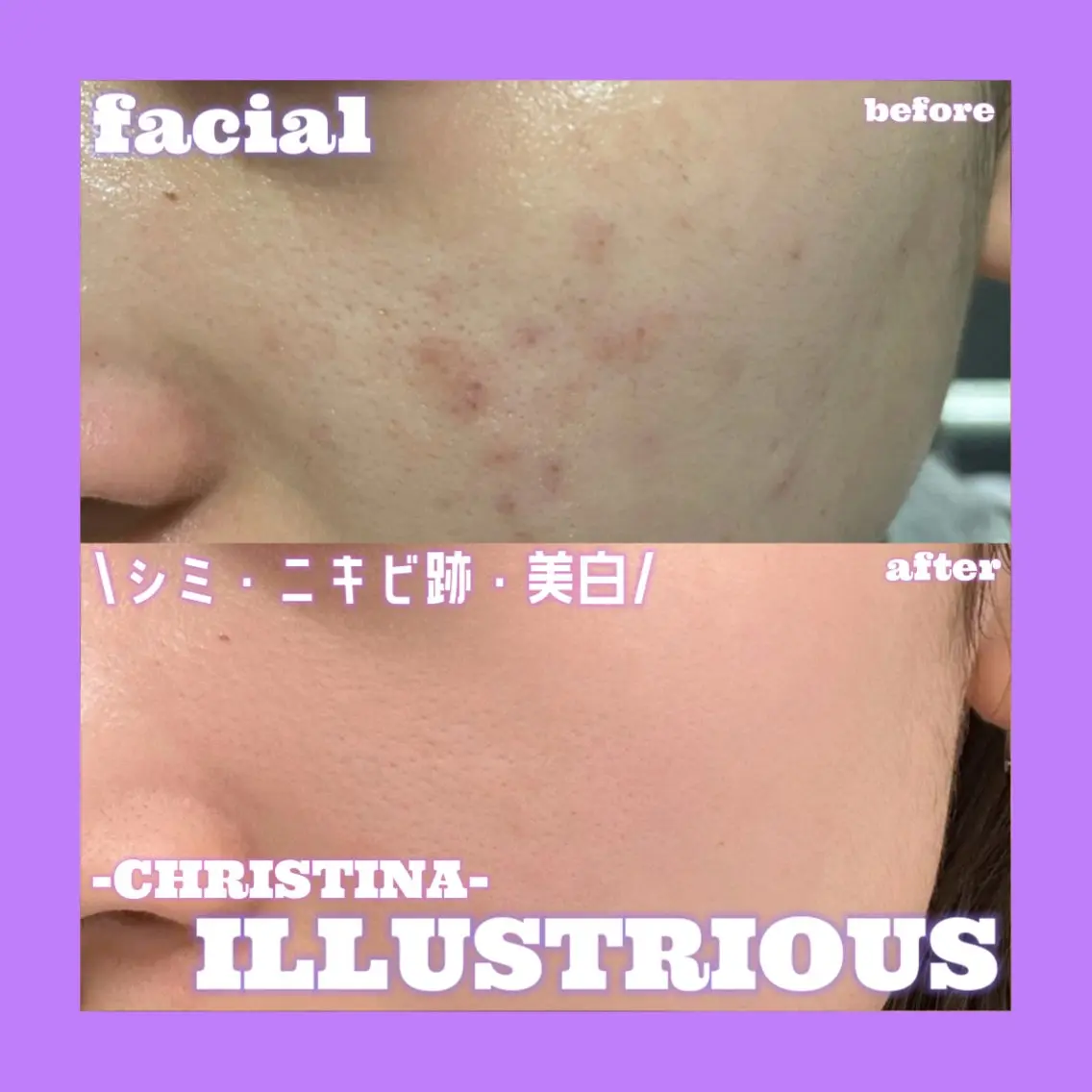 【💜夏に出来たシミを残さない💜】最強美白ピーリング💎シミ・ニキビ跡・色素沈着💫ニキビ跡にも効果的🙆♀️✨️の写真