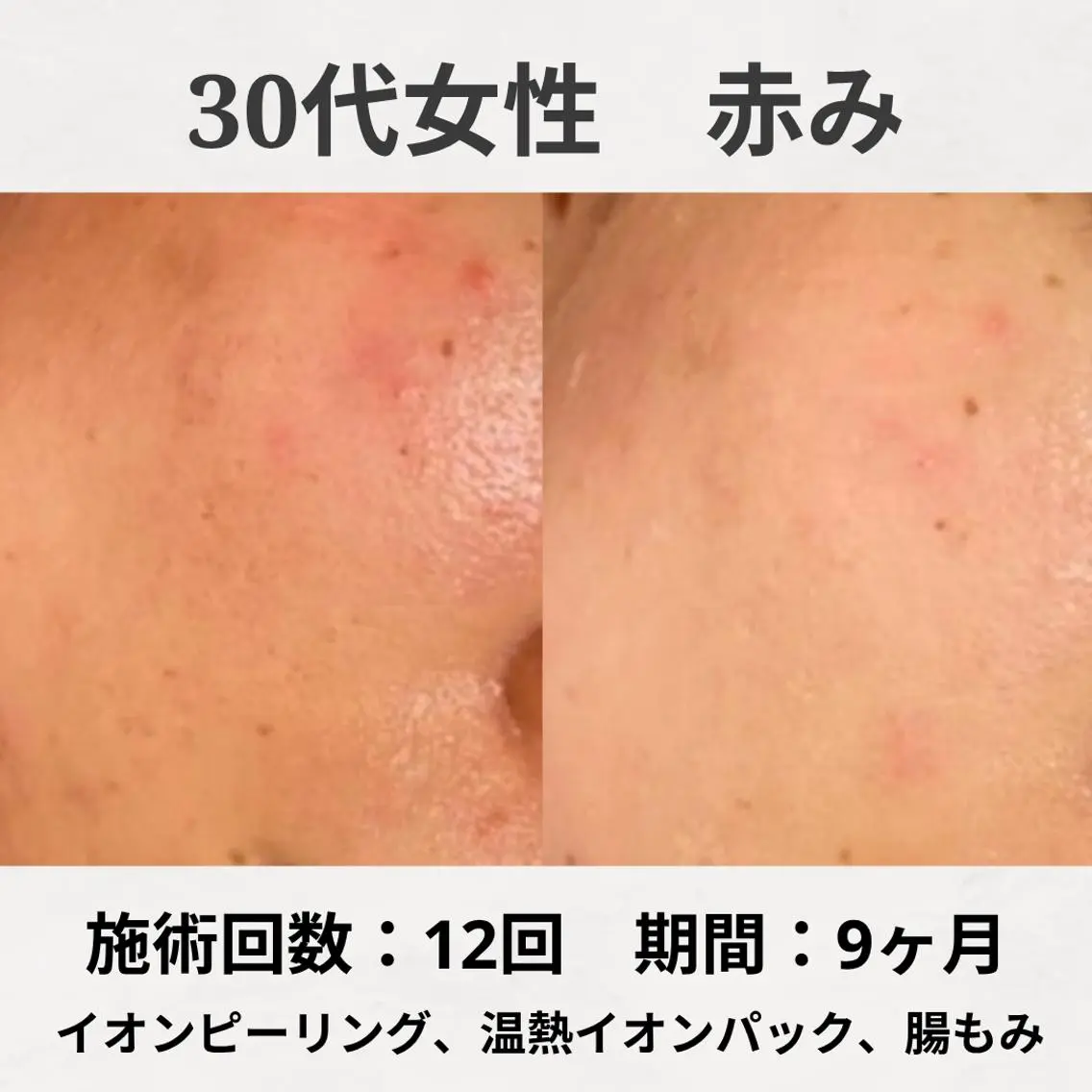 エステ リラク 繰り返すニキビ跡専門 根本改善のエステ・リラクイメージ