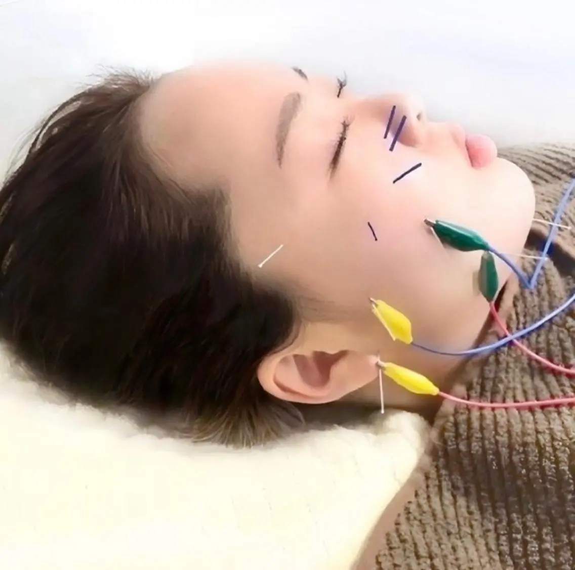 🌈ゼロメイクパルス美容鍼💡¥9,900↓🌈細胞の新陳代謝を促進❣️お肌の内側からアプローチして素肌に自信が持てるの写真