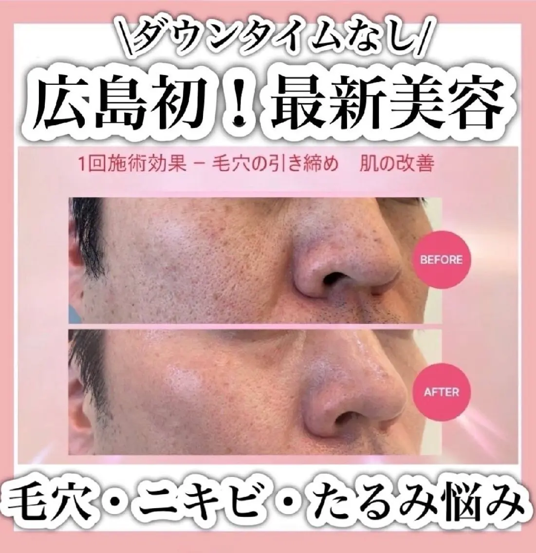 【お肌改善】短時間水光仕上げ！Airプラズマの写真