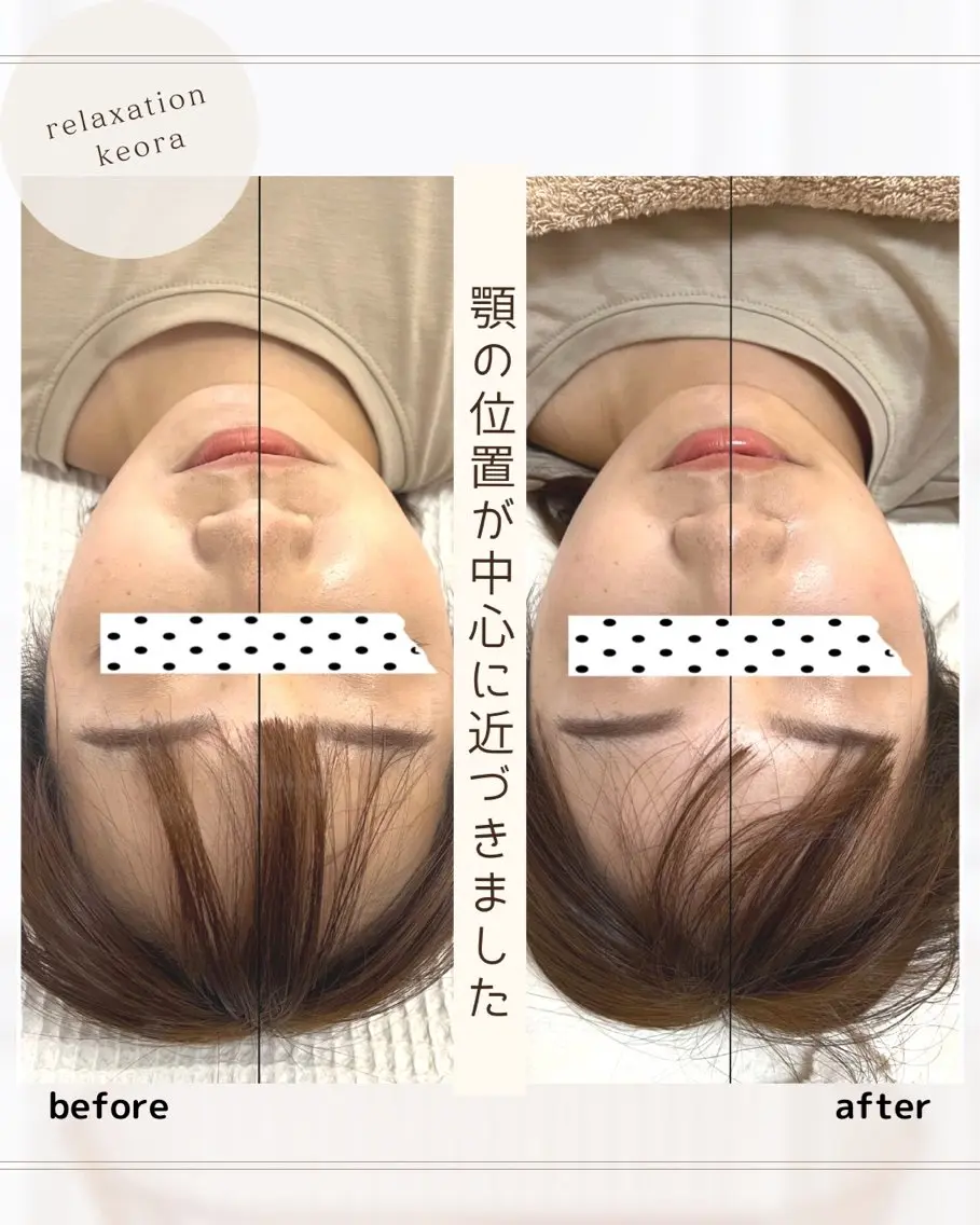 人気No.1 【小顔矯正】120分　エラ頬骨むくみたるみほうれい線左右差長年の悩みに∴結果重視！１回でも9割が効果実感◎の写真