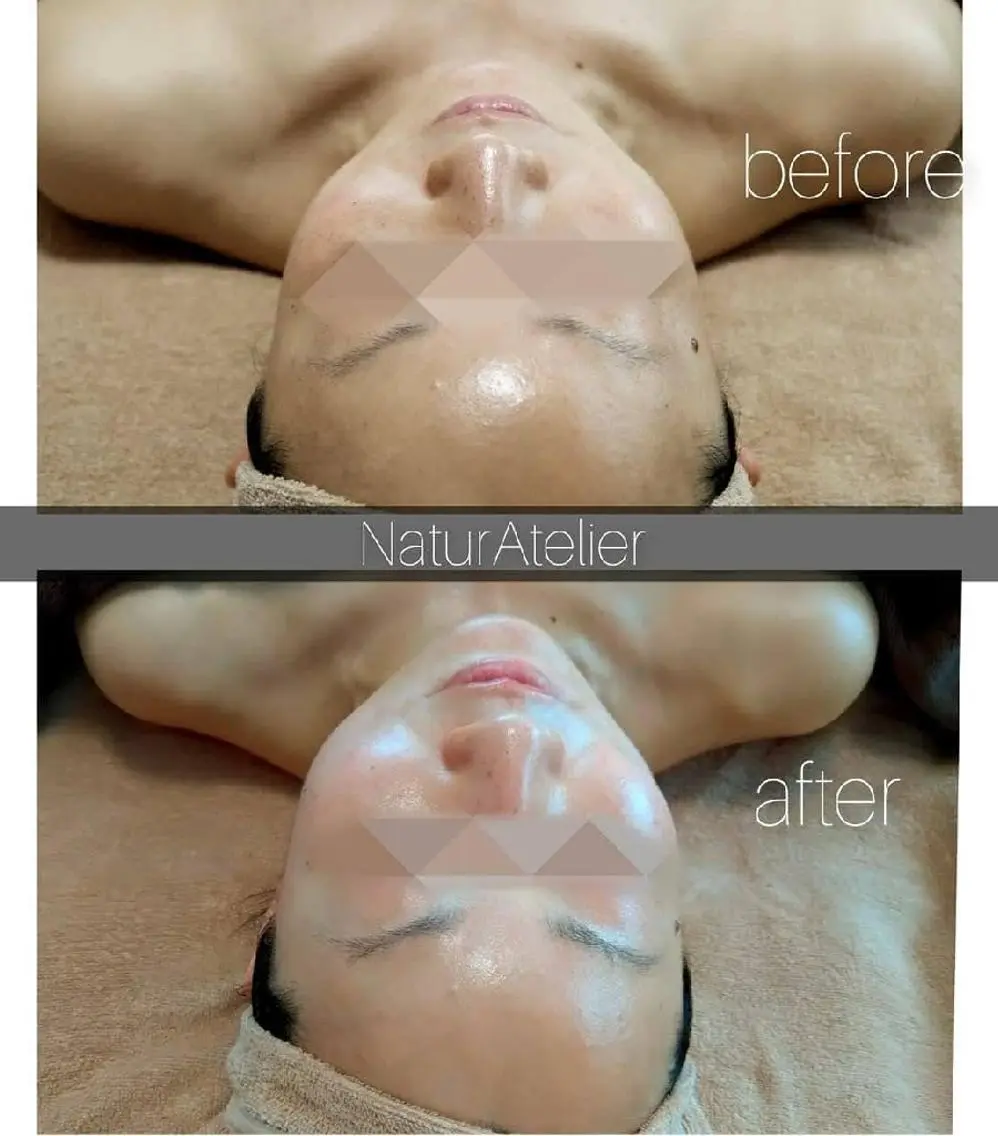 小顔コース症例モデル・モニターさん募集⭐《before/after》写真のご提供をお願いします。の写真