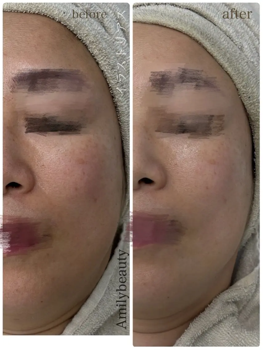エステ Amily beauty 毛利のその他イメージ