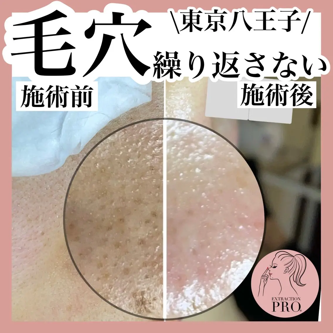 毛穴特化エステ -リールのエステ・リラクイメージ
