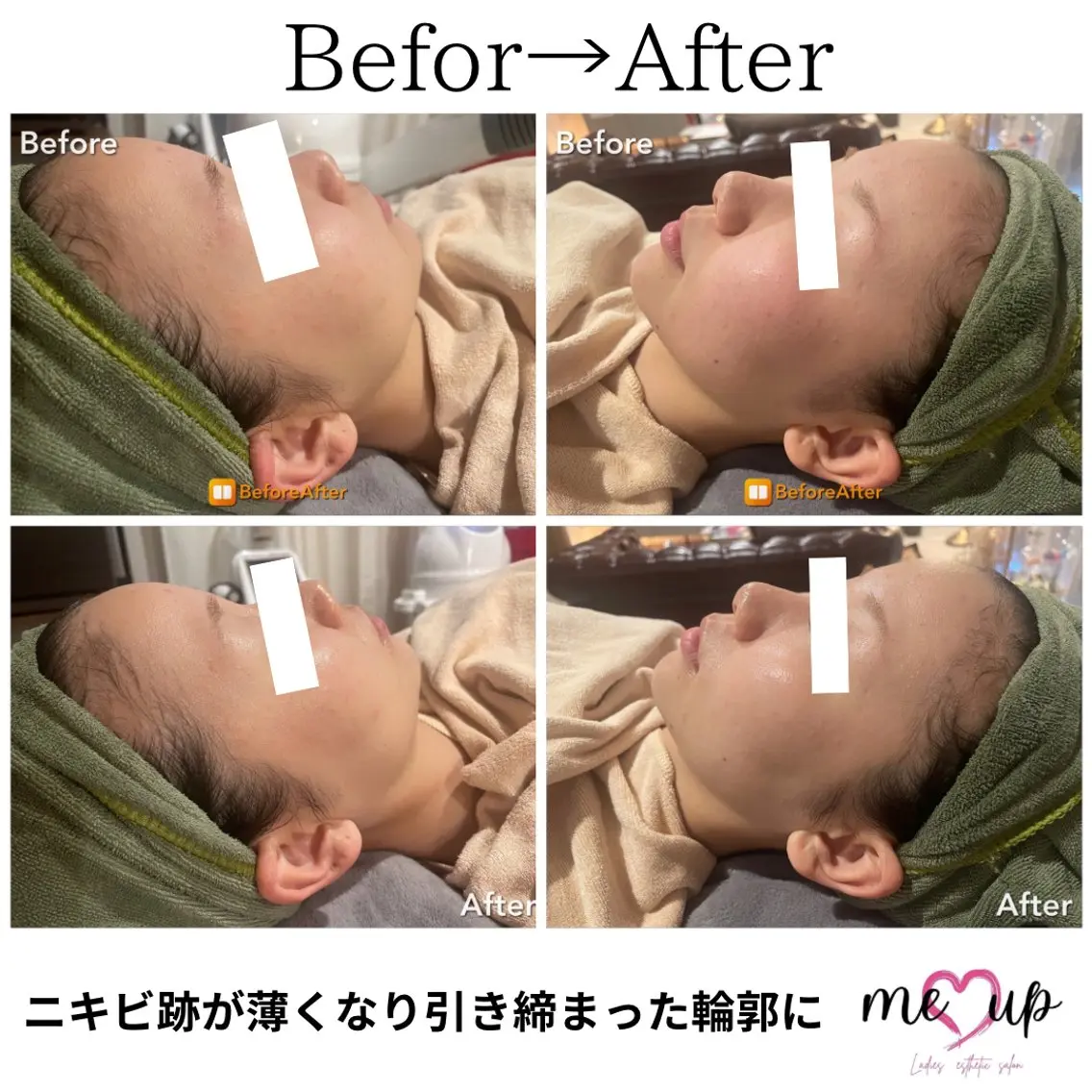 Meupニキビ専門店 背中/ハーブ/肌管理のその他イメージ